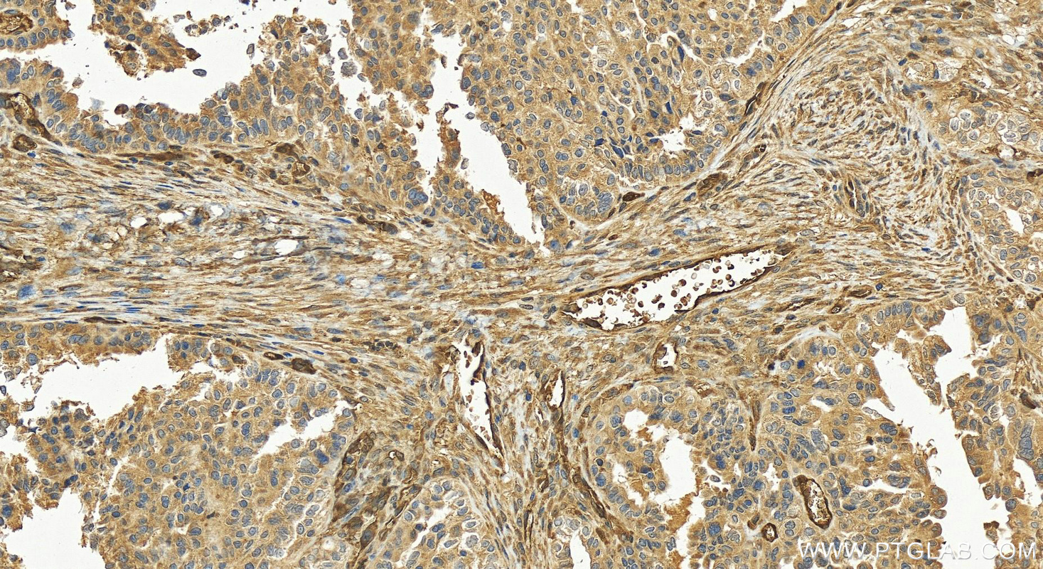 IHC staining of human ovary cancer using 17020-1-AP