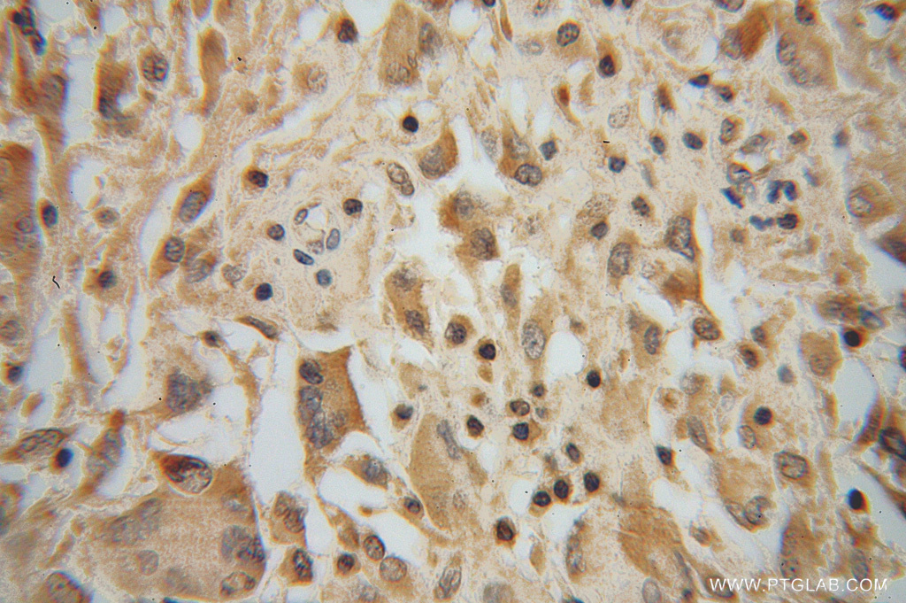 IHC staining of human gliomas using 14573-1-AP