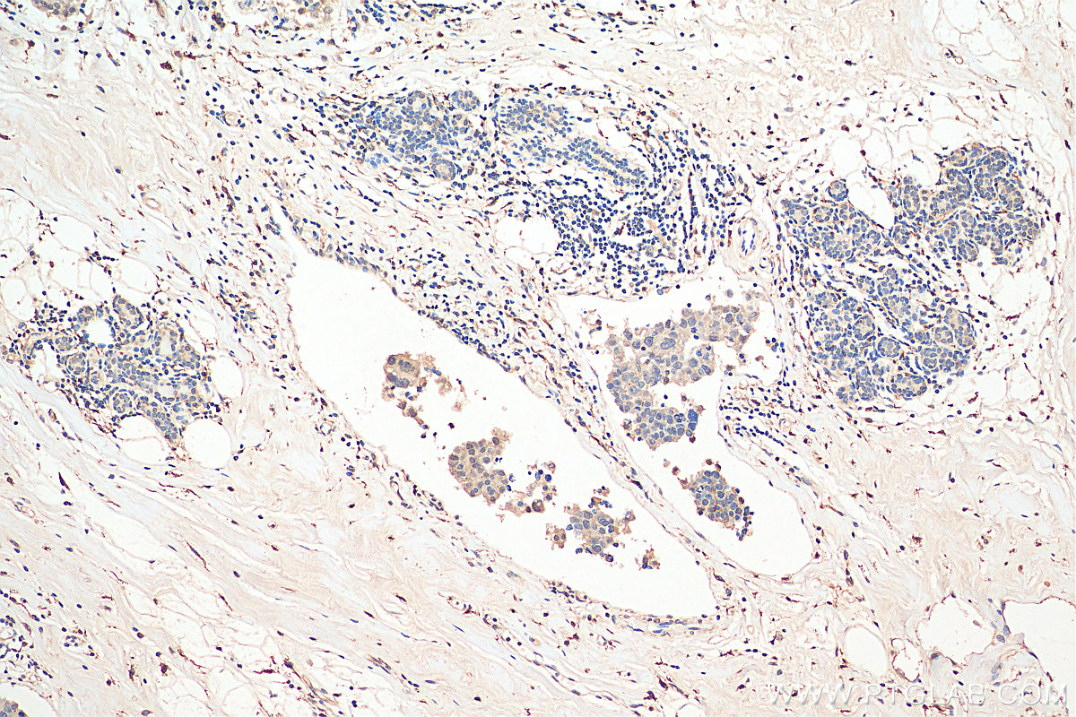 IHC staining of human breast cancer using 28617-1-AP