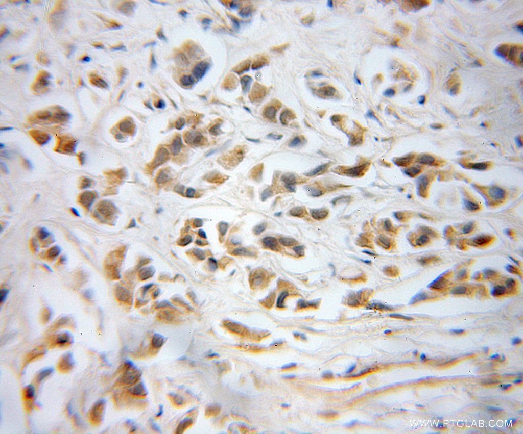 IHC staining of human prostate cancer using 10140-2-AP