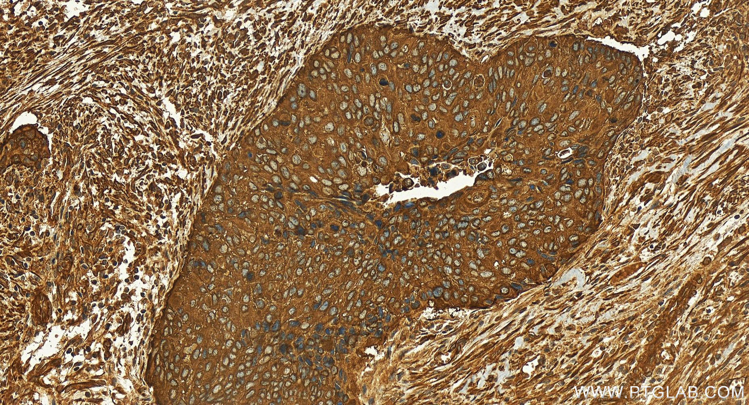 IHC staining of human cervical squamous cancer using 18590-1-AP