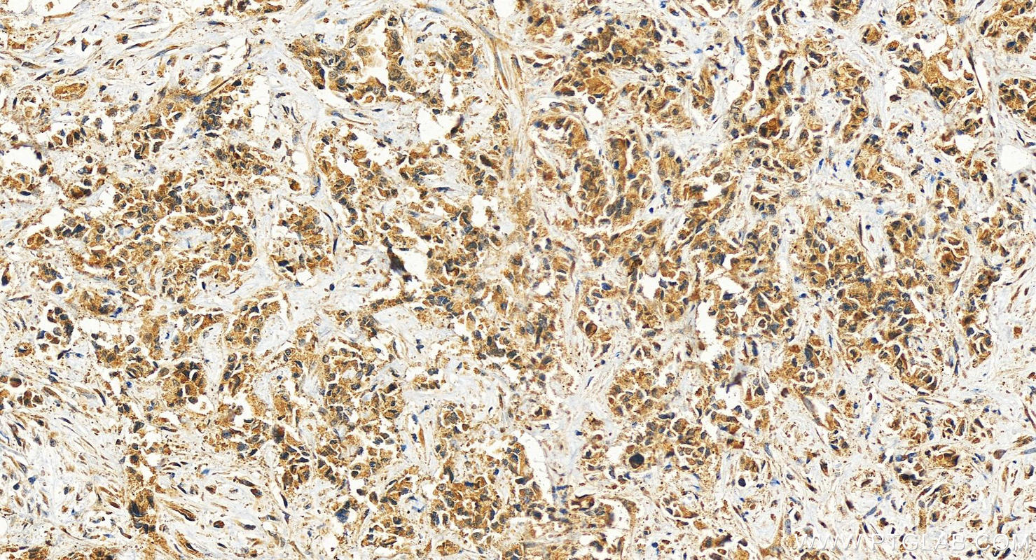 IHC staining of human intrahepatic cholangiocarcinoma using 27285-1-AP