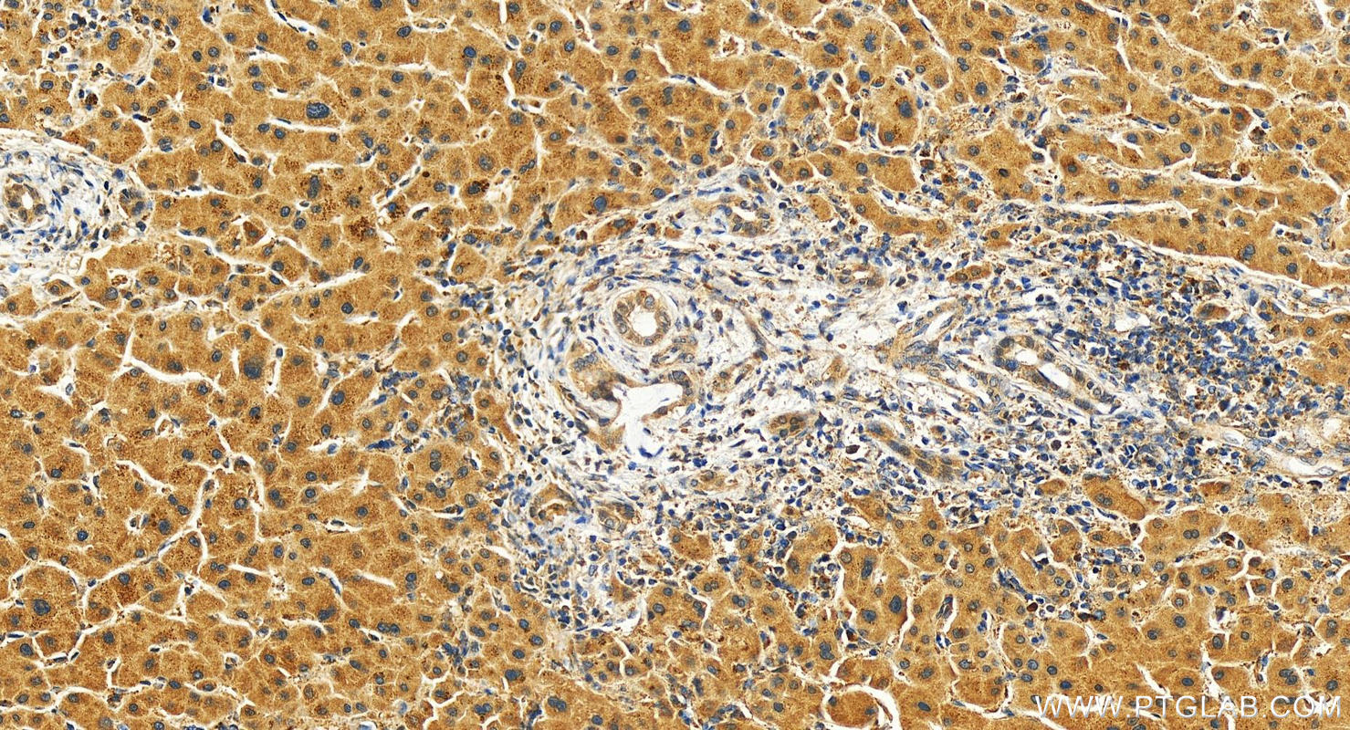 IHC staining of human intrahepatic cholangiocarcinoma using 27285-1-AP