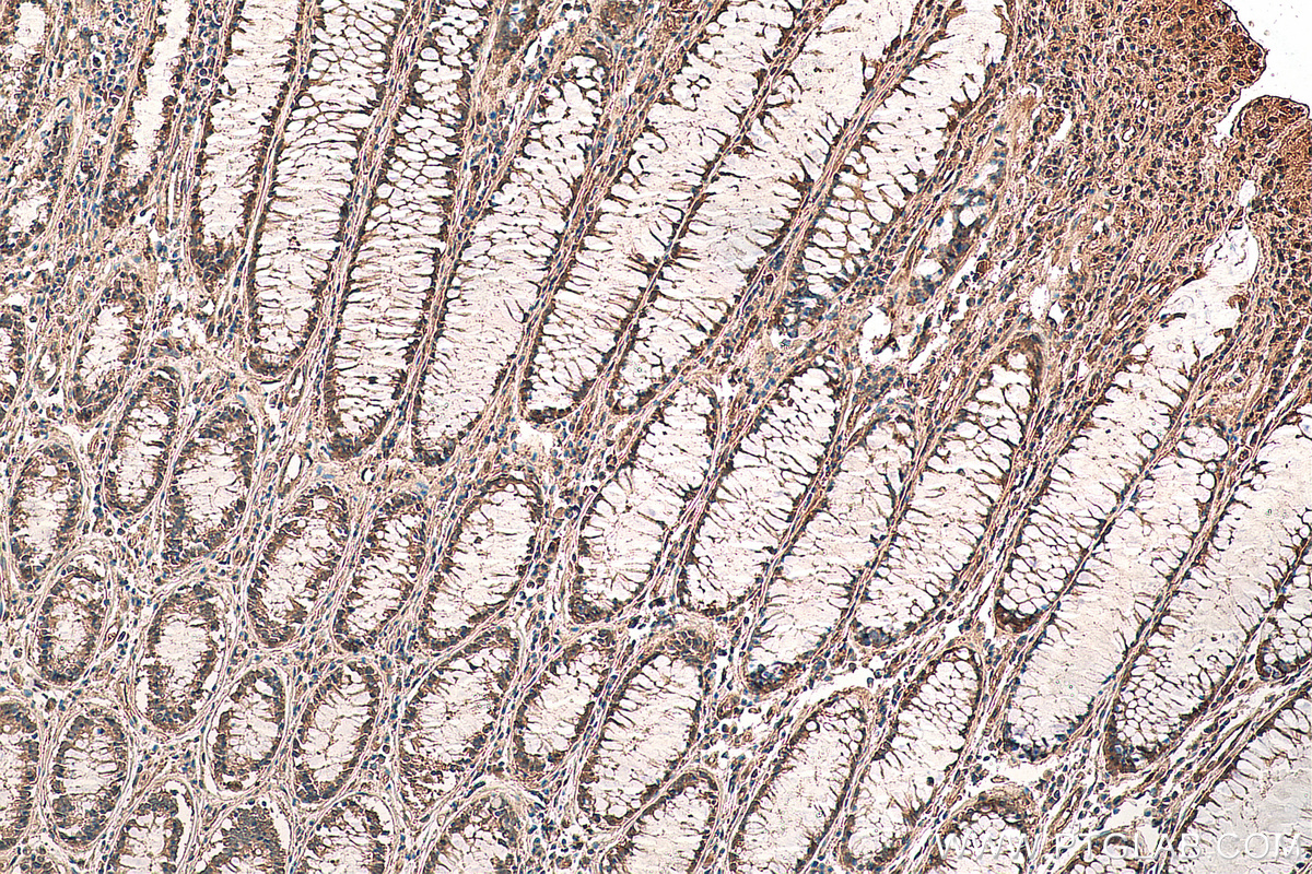 IHC staining of human colon cancer using 29424-1-AP (same clone as 29424-1-PBS)