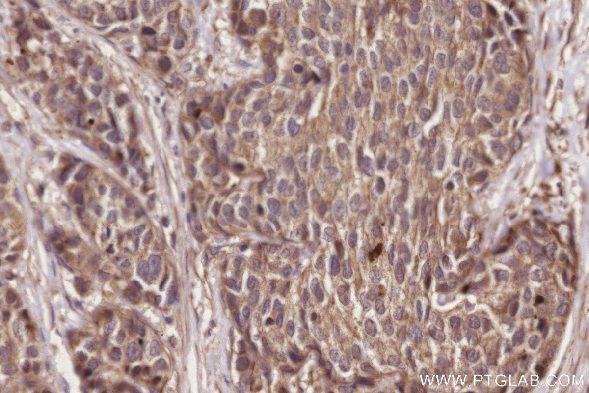 IHC staining of human stomach cancer using 55129-1-AP IHC staining of human stomach cancer using 55129-1-AP