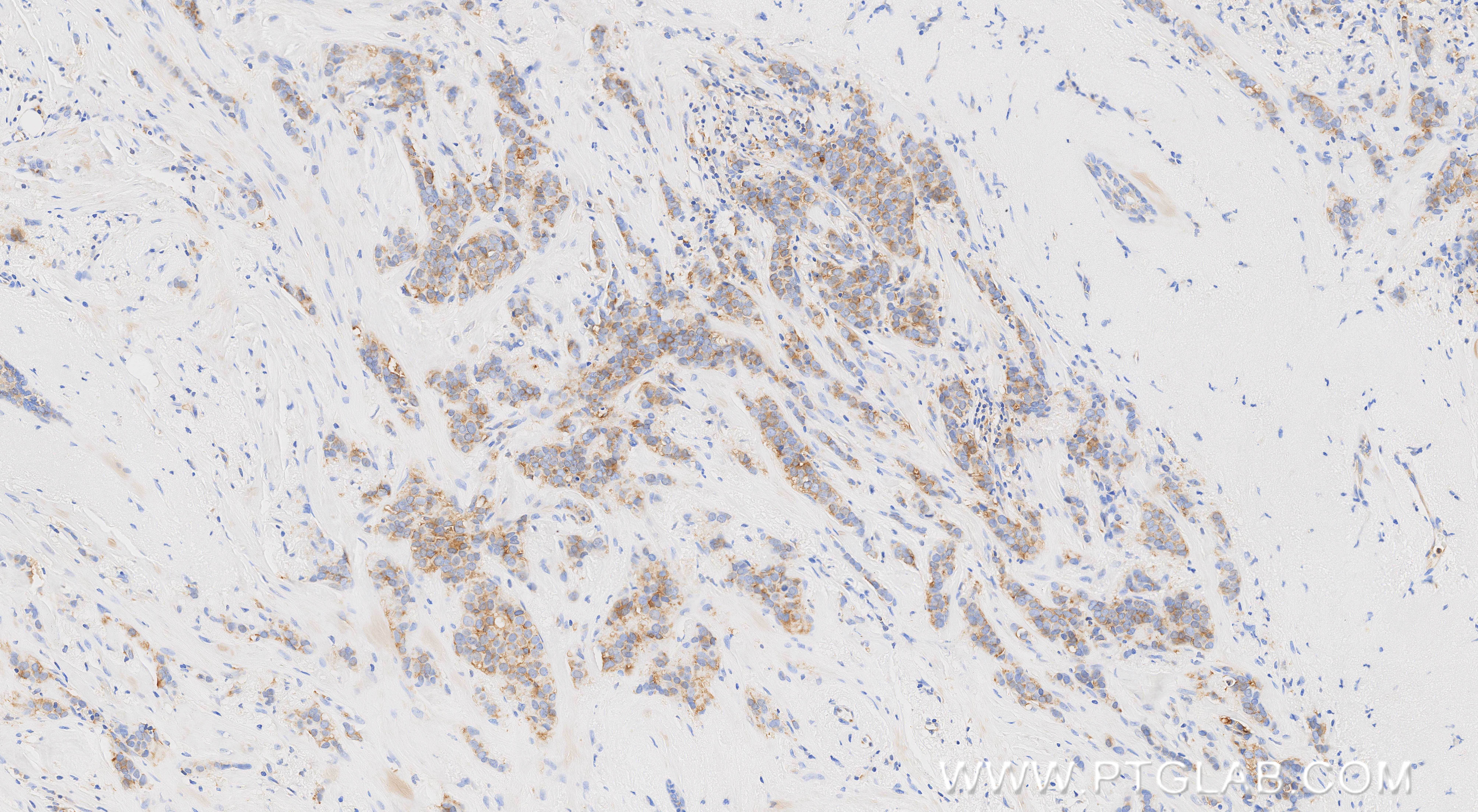 IHC staining of human breast cancer using 86383-1-RR