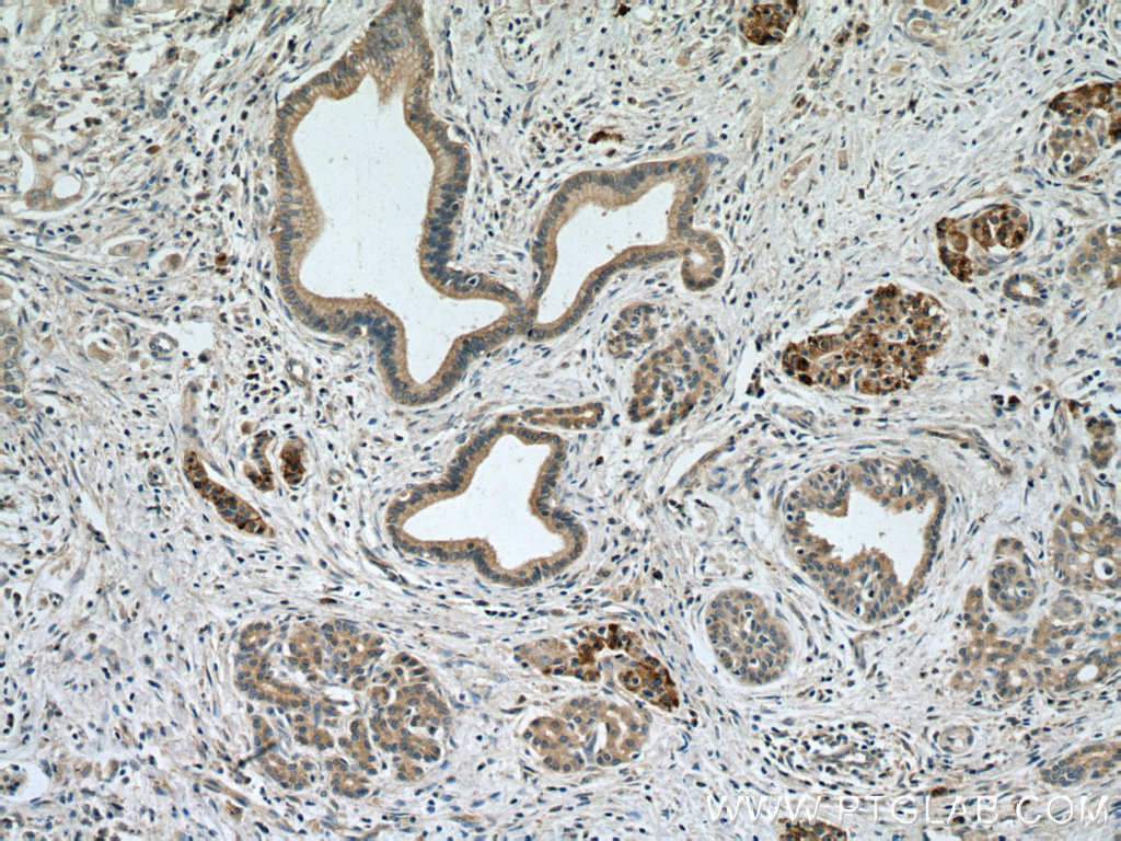 IHC staining of human pancreas cancer using 12675-2-AP (same clone as 12675-2-PBS)