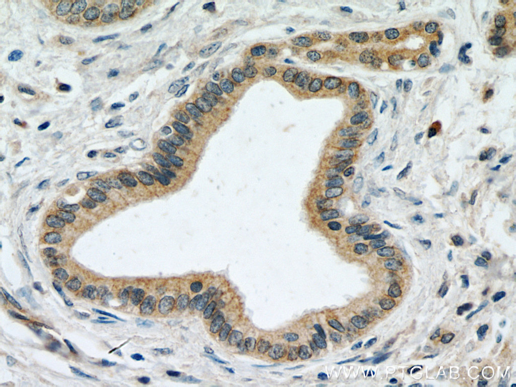 IHC staining of human pancreas cancer using 12675-2-AP (same clone as 12675-2-PBS)