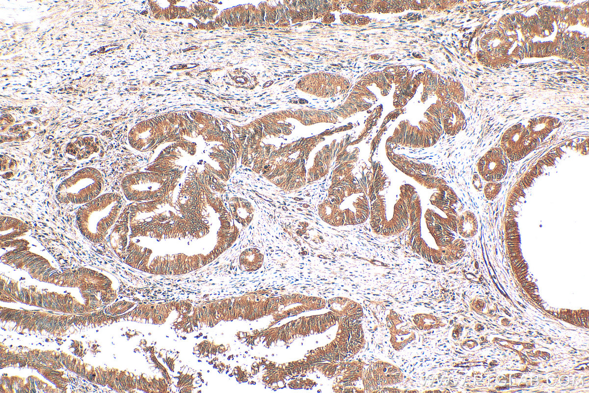 IHC staining of human pancreas cancer using 12675-2-AP