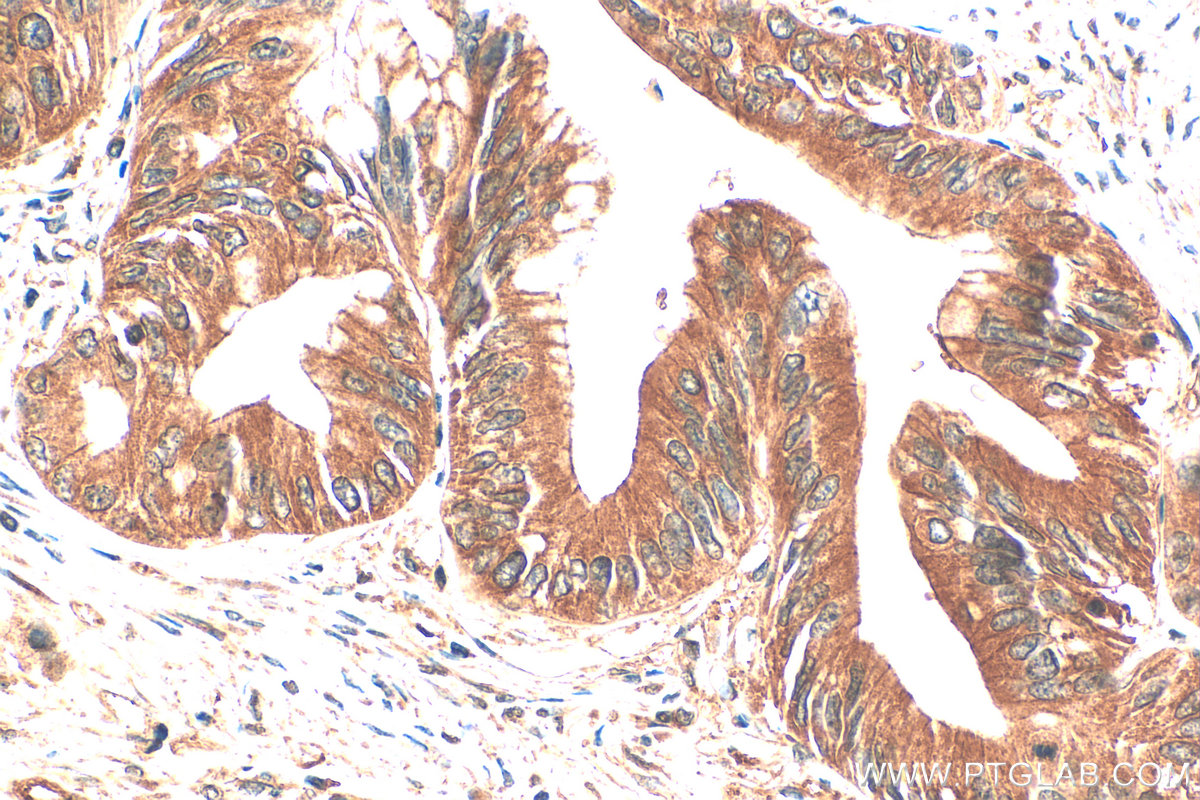 IHC staining of human pancreas cancer using 12675-2-AP