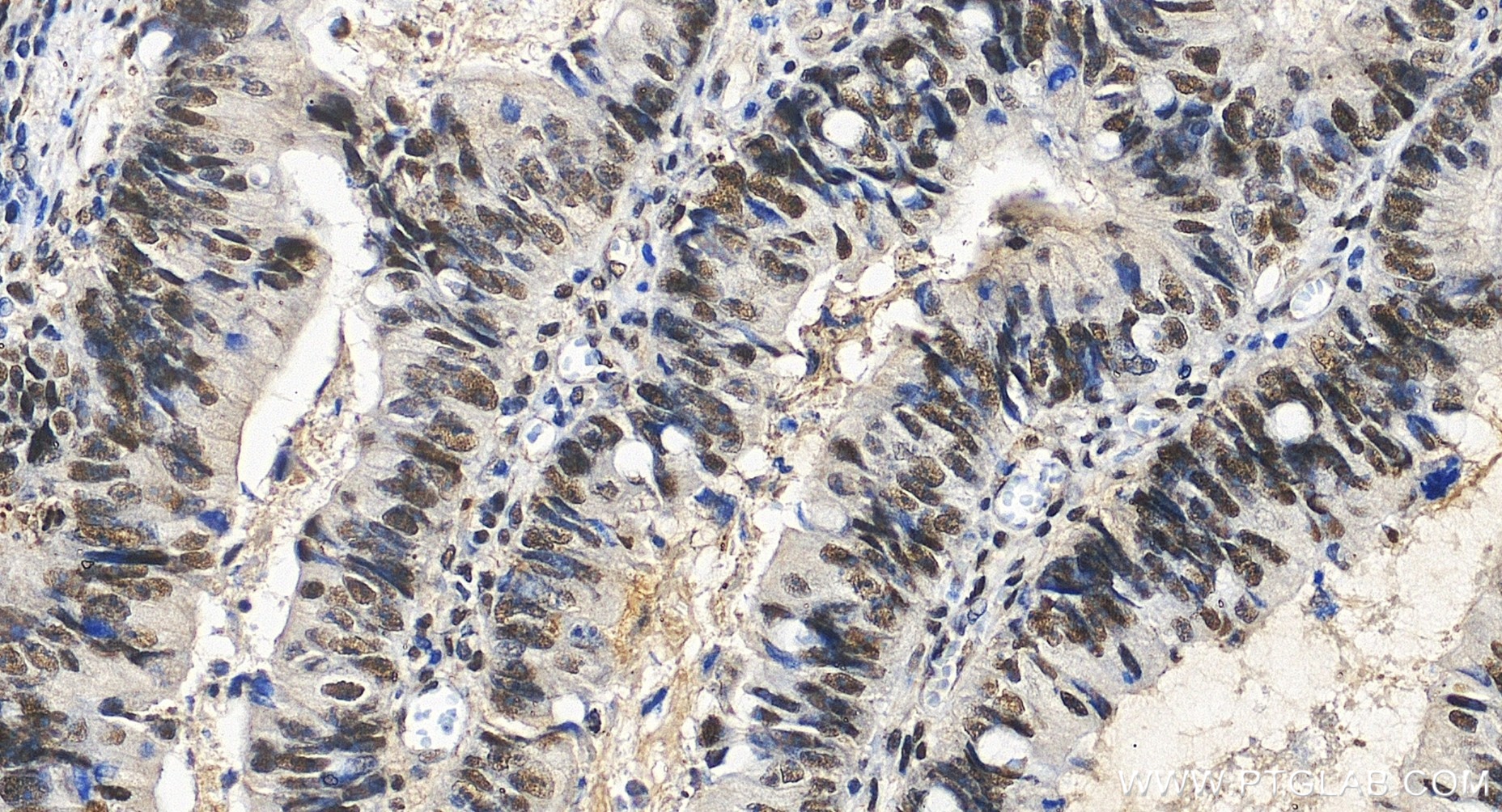 IHC staining of human colon cancer using 86600-3-RR