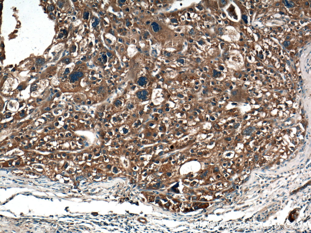 IHC staining of human liver cancer using 27805-1-AP