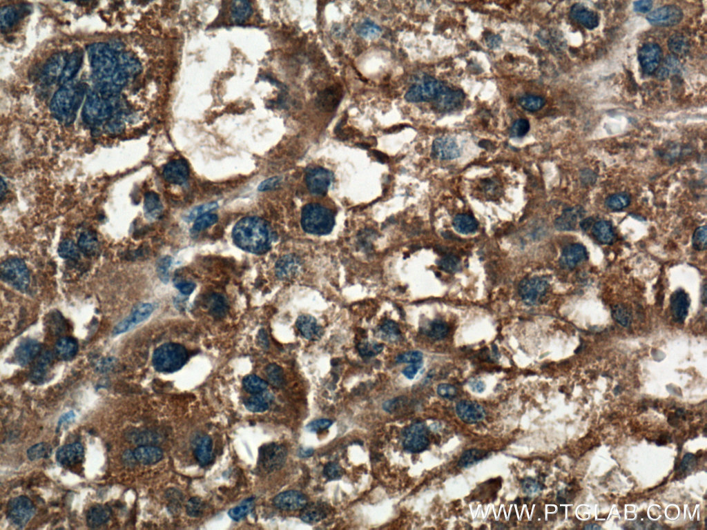 IHC staining of human liver cancer using 27805-1-AP