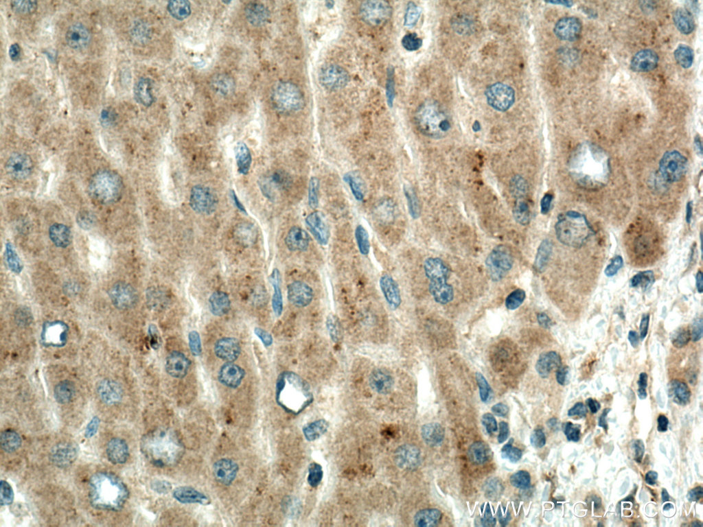 IHC staining of human liver cancer using 67392-1-Ig