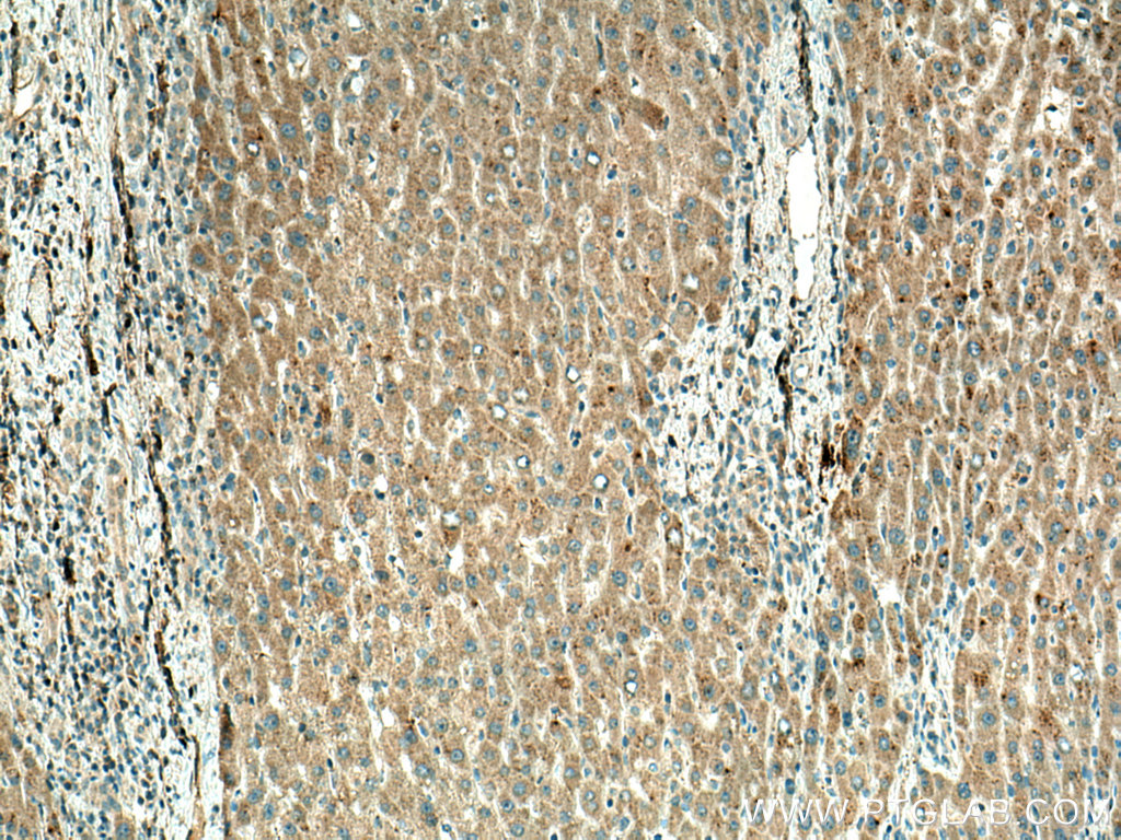 IHC staining of human liver cancer using 67392-1-Ig