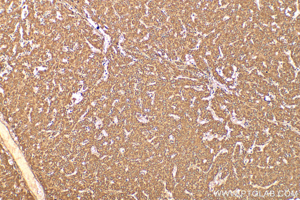 Immunohistochemical analysis of paraffin-embedded human liver cancer tissue slide using 20517-1-AP (PPPDE1/PNAS4 antibody) at dilution of 1:200 (under 10x lens). Heat mediated antigen retrieval with Tris-EDTA buffer (pH 9.0). IHC staining of human liver cancer using 20517-1-AP