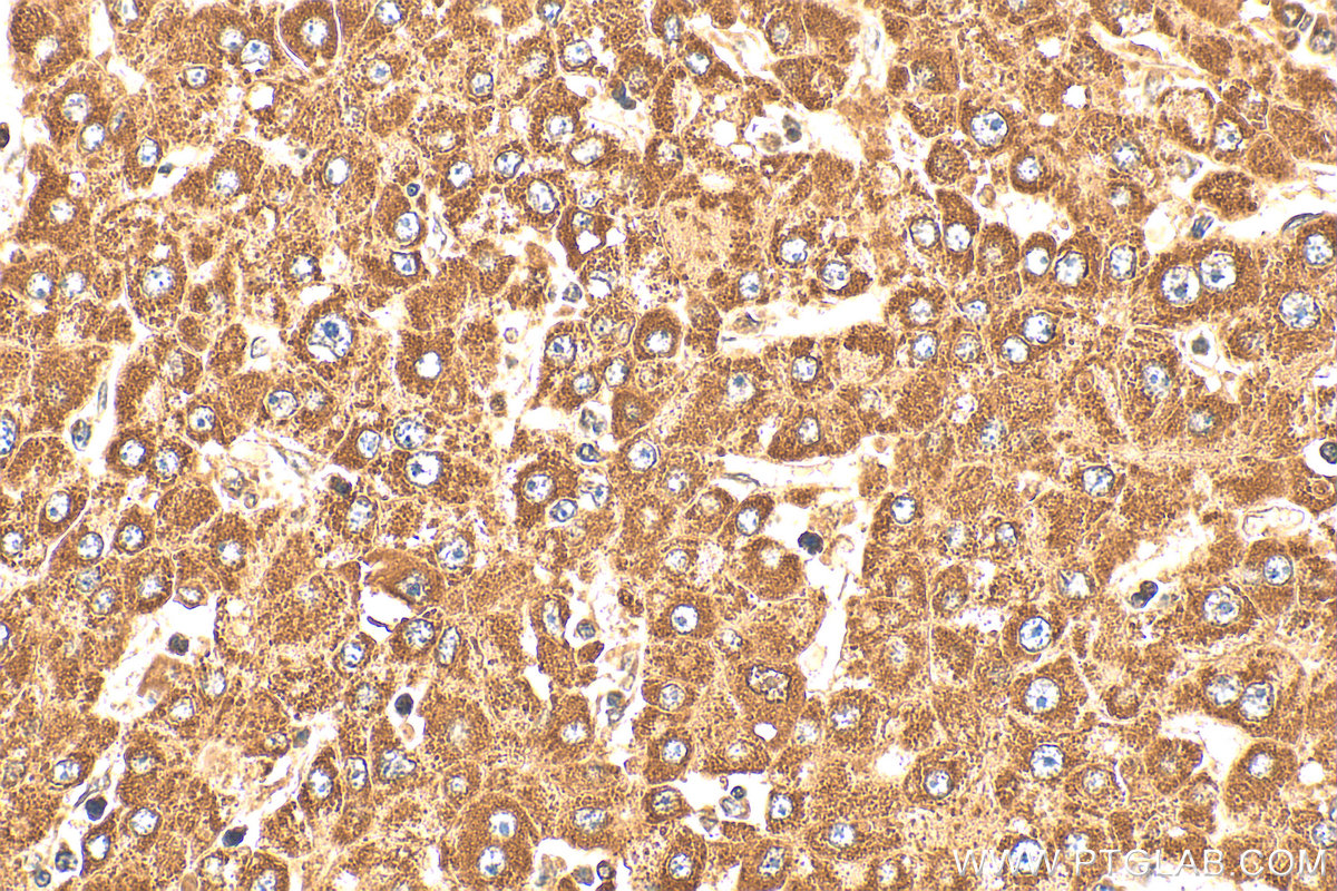 Immunohistochemical analysis of paraffin-embedded human liver cancer tissue slide using 20517-1-AP (PPPDE1/PNAS4 antibody) at dilution of 1:200 (under 40x lens). Heat mediated antigen retrieval with Tris-EDTA buffer (pH 9.0). IHC staining of human liver cancer using 20517-1-AP