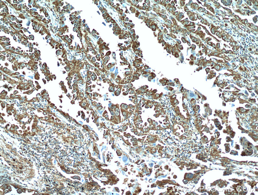 IHC staining of human lung cancer using 20517-1-AP