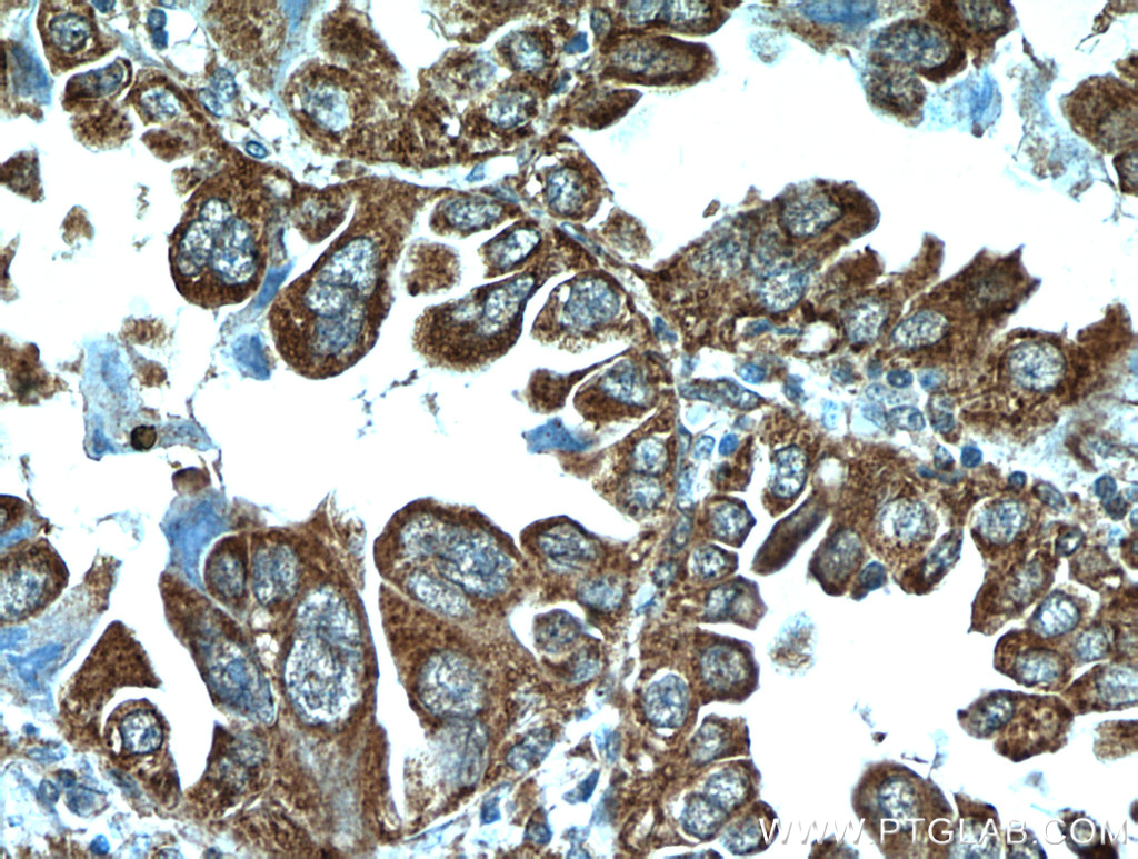 IHC staining of human lung cancer using 20517-1-AP