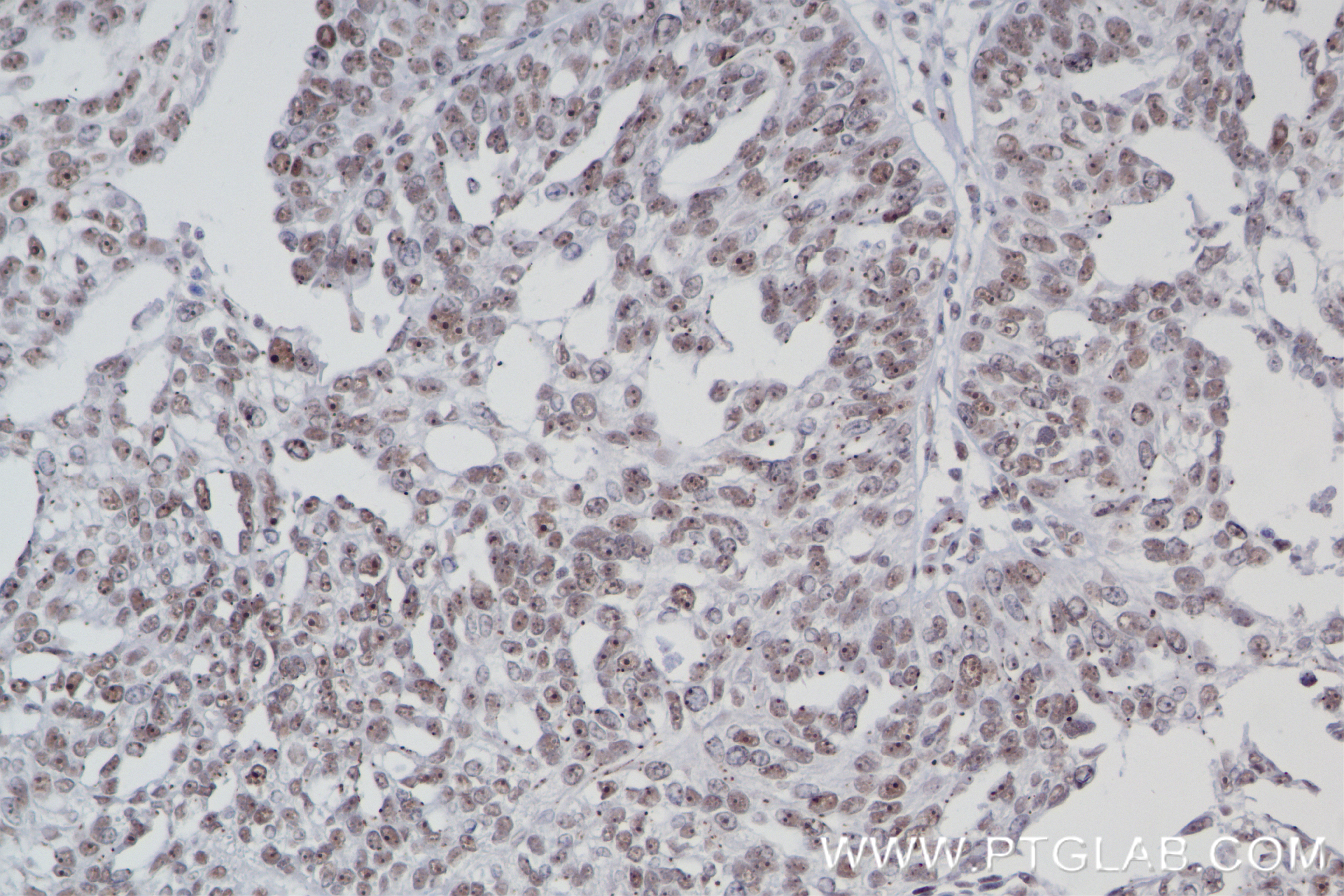 IHC staining of human ovary cancer using 84491-6-RR