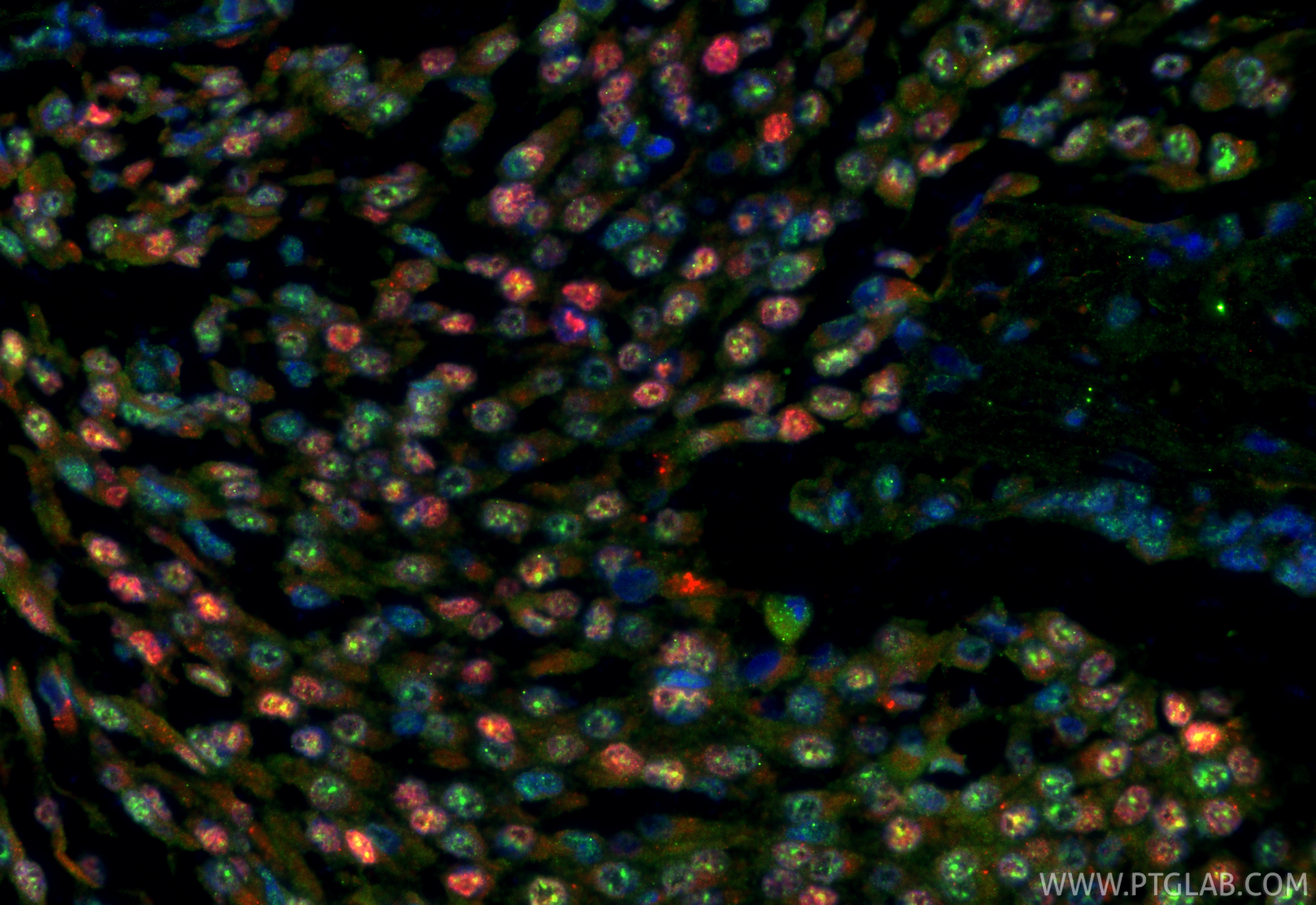 IF Staining of human breast cancer using 25871-1-AP