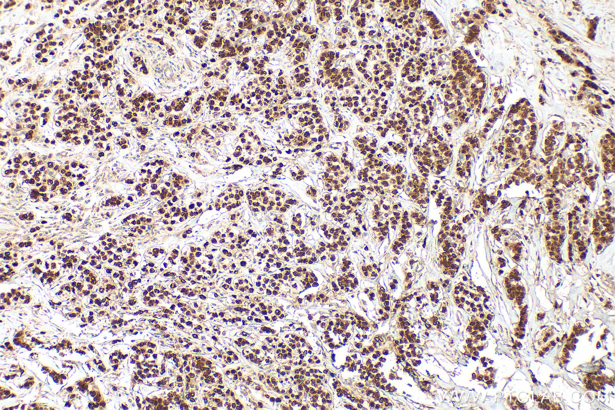 IHC staining of human breast cancer using 25871-1-AP IHC staining of human breast cancer using 25871-1-AP