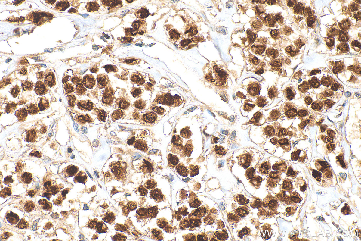 IHC staining of human breast cancer using 25871-1-AP IHC staining of human breast cancer using 25871-1-AP