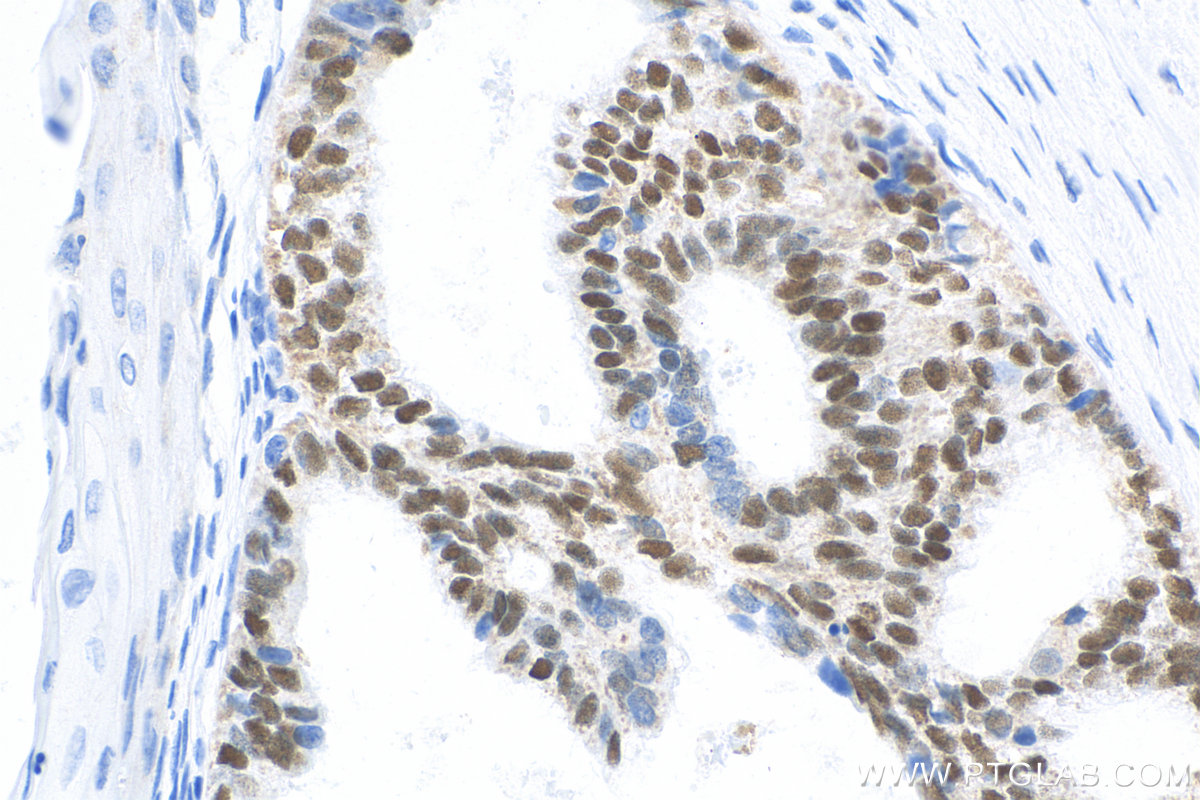 IHC staining of human ovary tumor using Biotin-66300