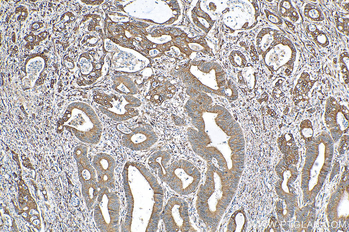 IHC staining of human colon cancer using 10110-2-AP