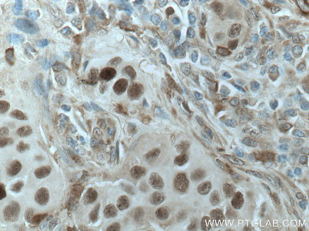 IHC staining of human breast cancer using 67027-1-Ig (same clone as 67027-1-PBS)