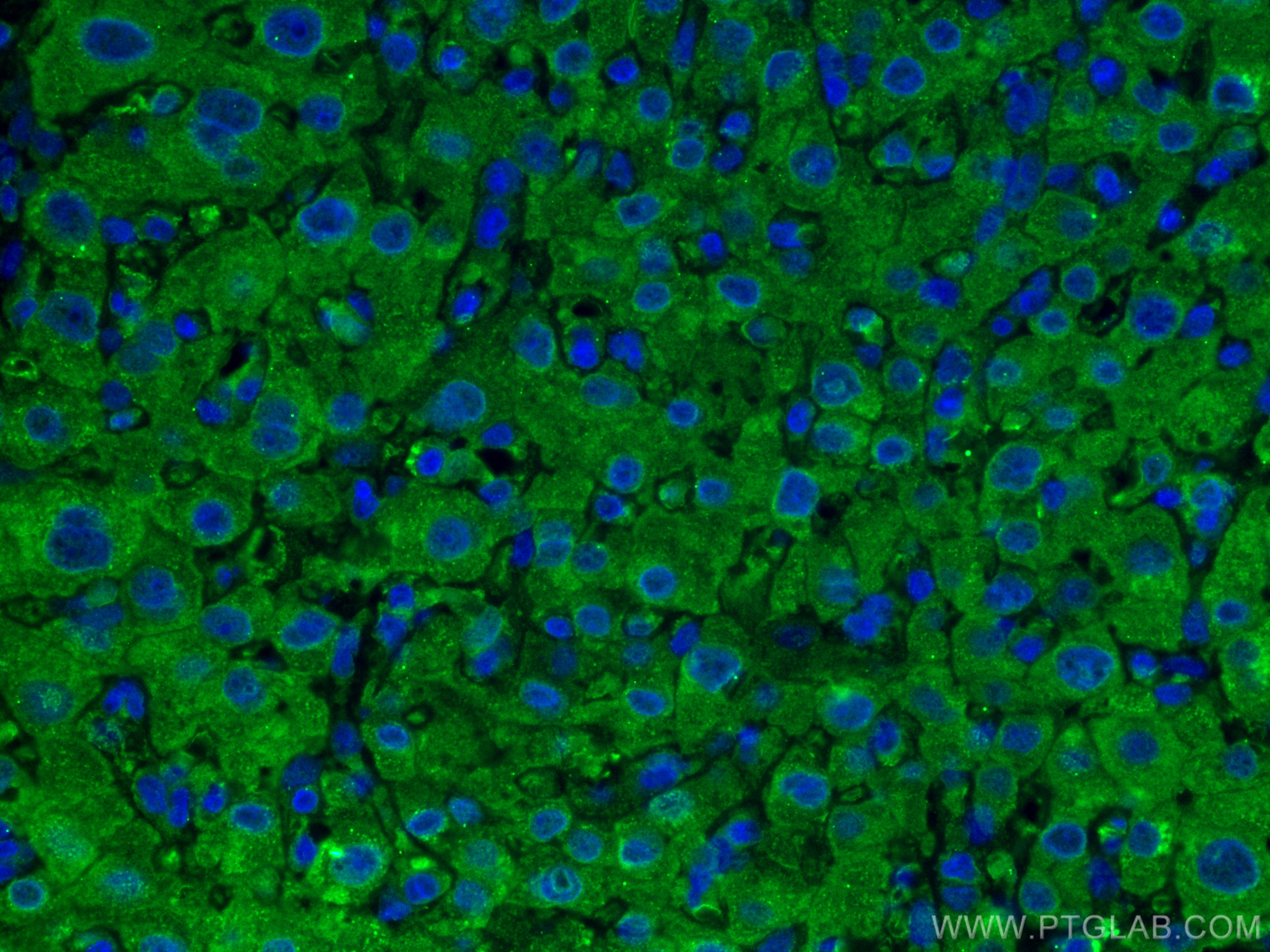 IF Staining of human liver cancer using 66820-1-Ig (same clone as 66820-1-PBS)