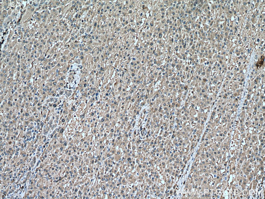 IHC staining of human liver cancer using 66820-1-Ig