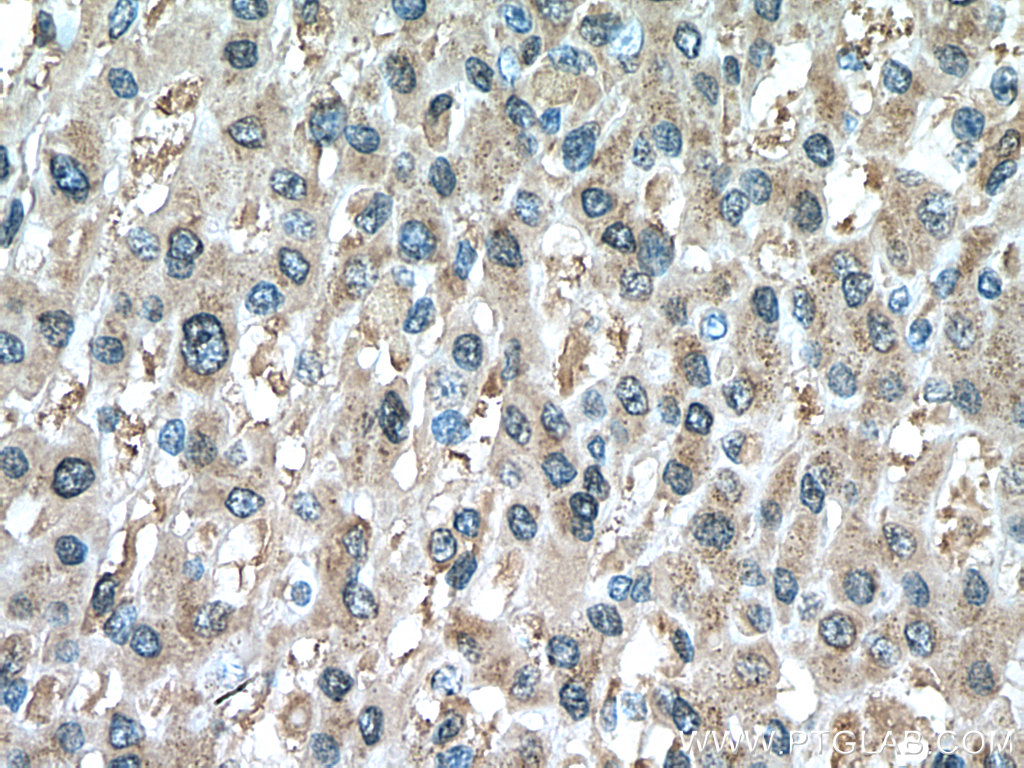 IHC staining of human liver cancer using 66820-1-Ig