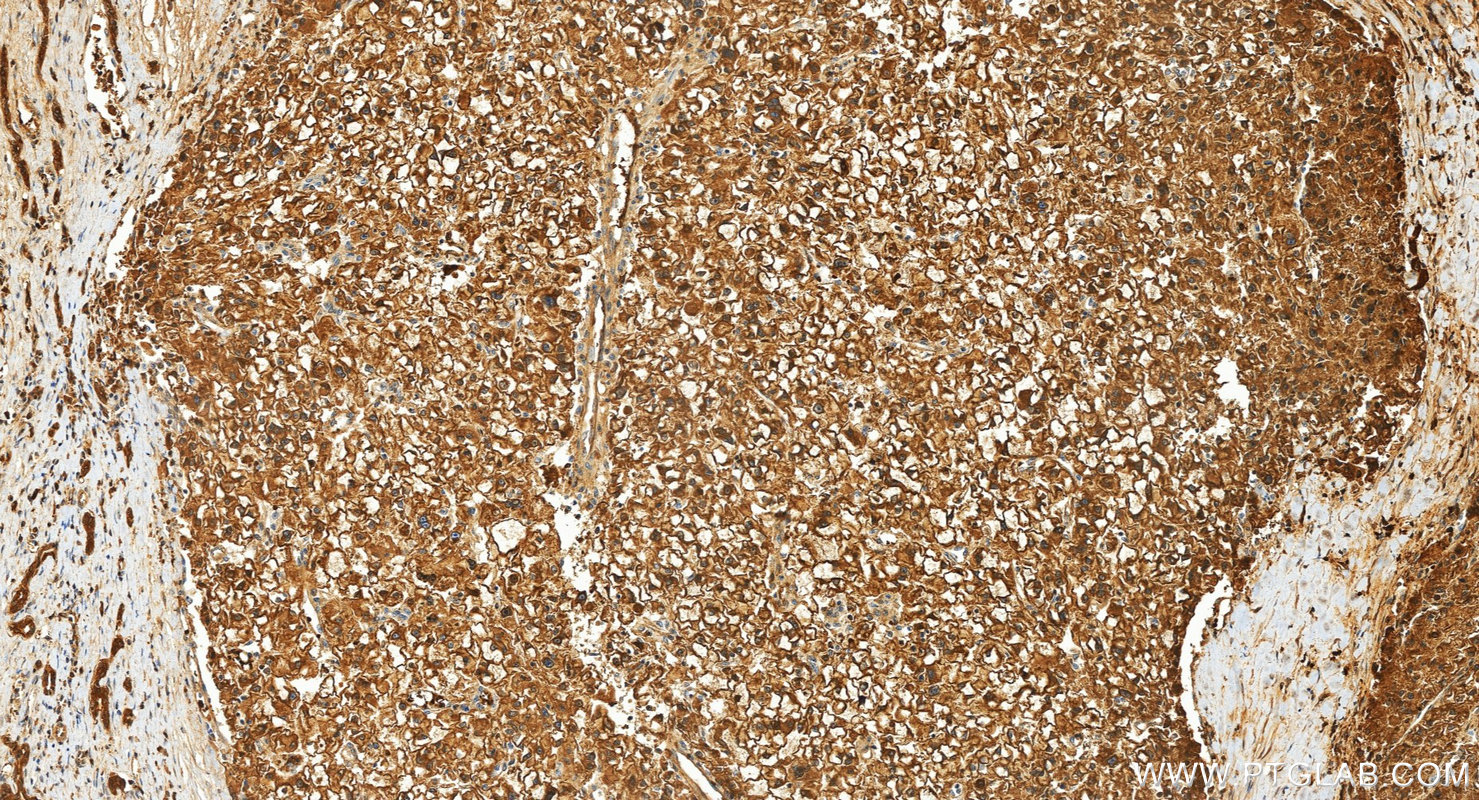 IHC staining of human liver cancer using 60202-1-Ig