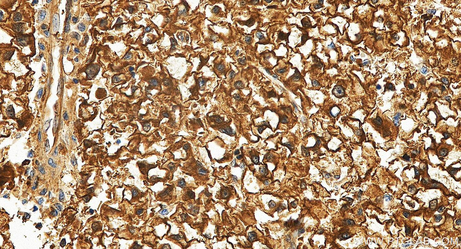 IHC staining of human liver cancer using 60202-1-Ig