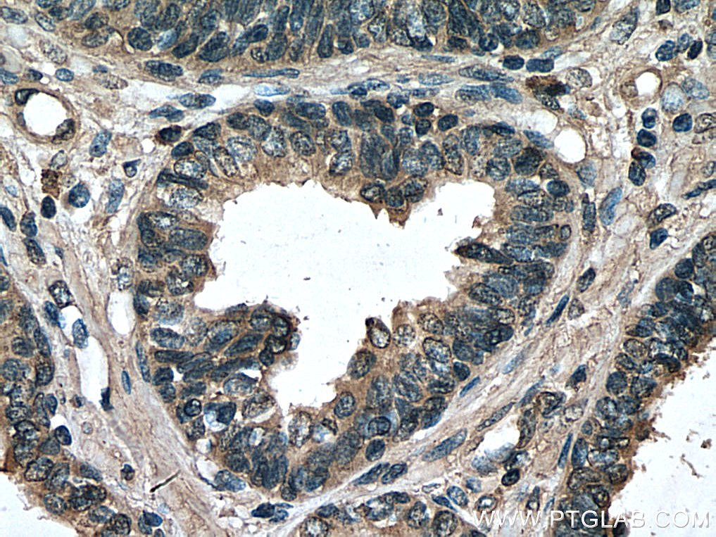 IHC staining of human prostate cancer using 66981-1-Ig