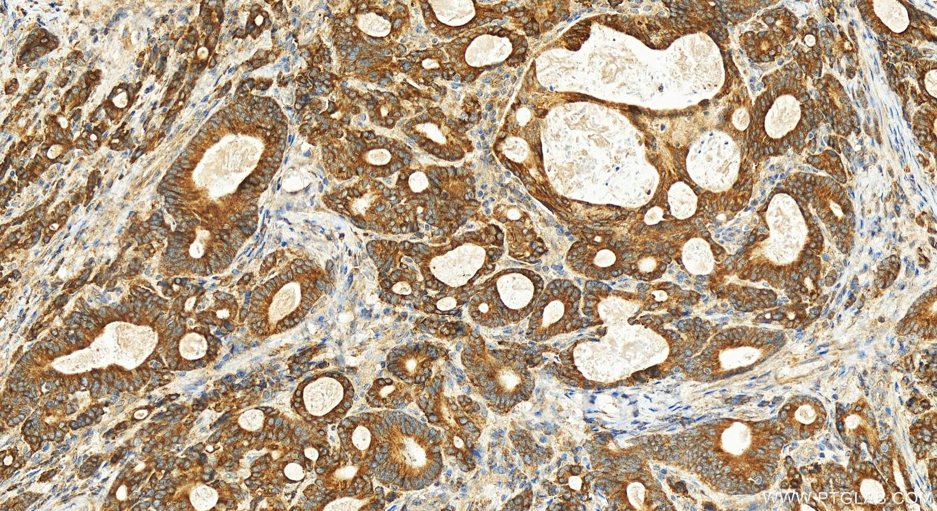 IHC staining of human stomach cancer using 23783-1-AP