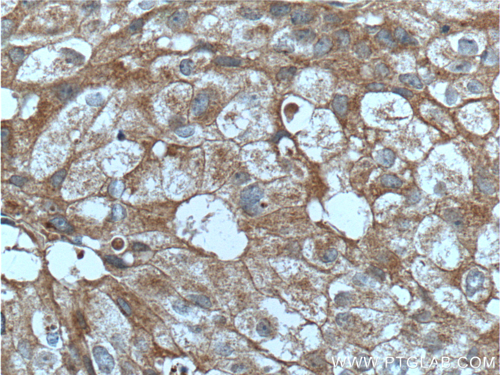 IHC staining of human breast cancer using 10766-1-AP