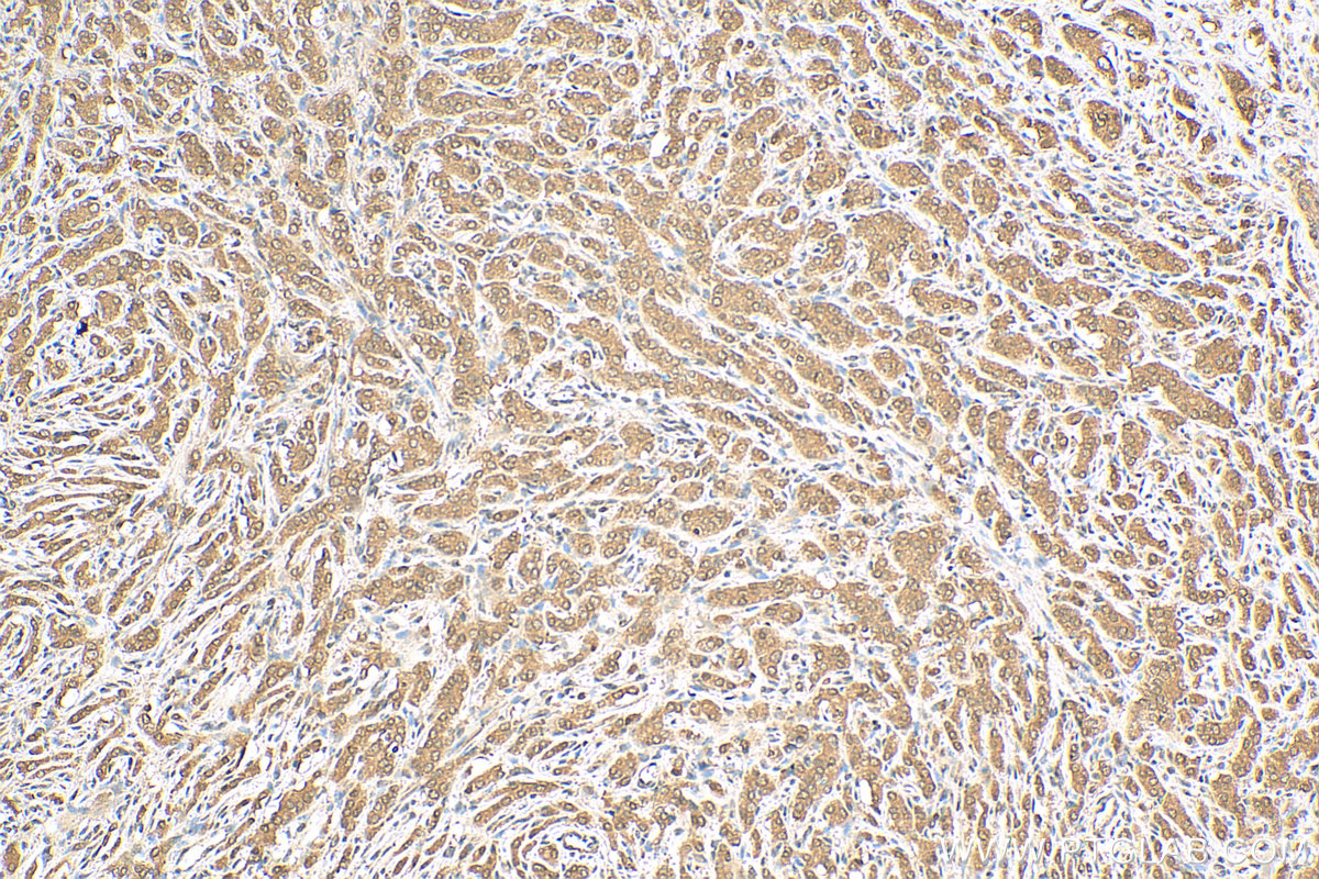 IHC staining of human prostate cancer using 10929-2-AP