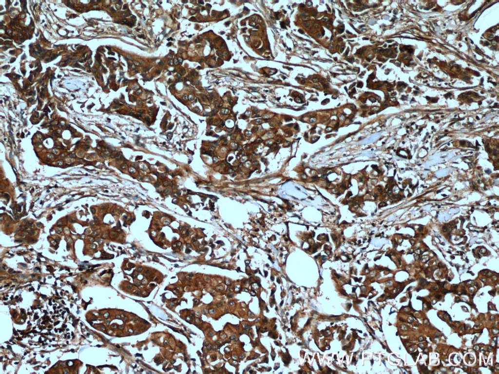 IHC staining of human breast cancer using 18167-1-AP