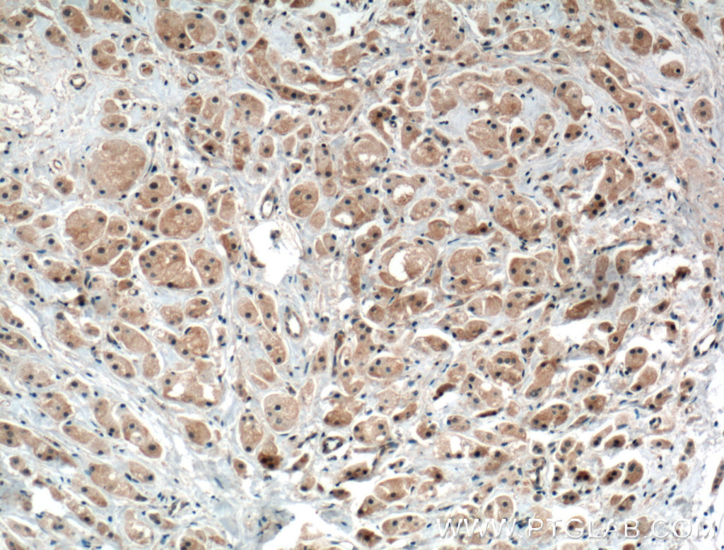 IHC staining of human breast cancer using 17991-1-AP