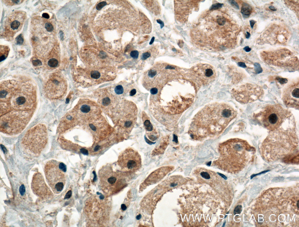 IHC staining of human breast cancer using 17991-1-AP