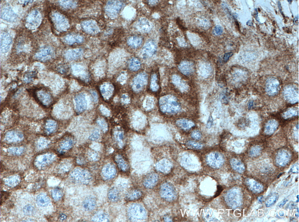IHC staining of human breast cancer using 12919-1-AP