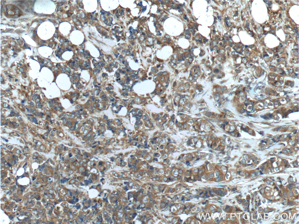 IHC staining of human breast cancer using 10860-1-AP