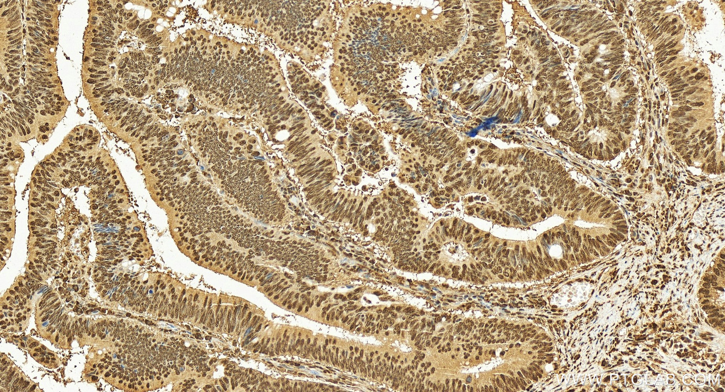 IHC staining of human colon cancer using 85370-2-RR