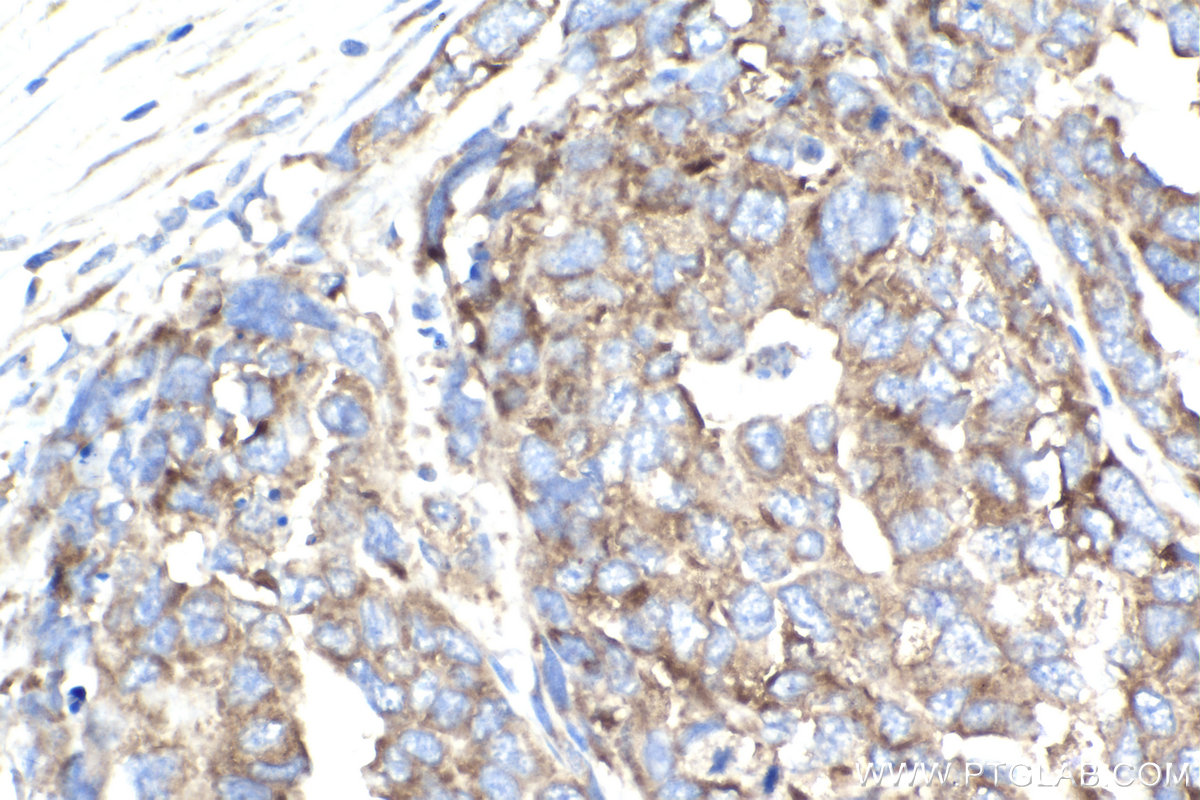 IHC staining of human ovary cancer using 68518-1-Ig (same clone as 68518-1-PBS)