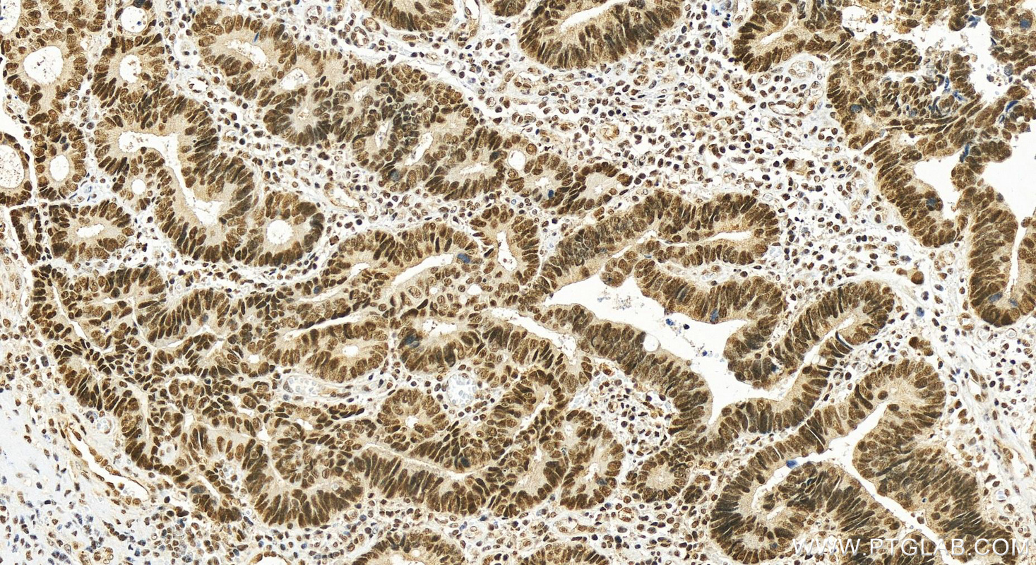 IHC staining of human colon cancer using 16794-1-AP