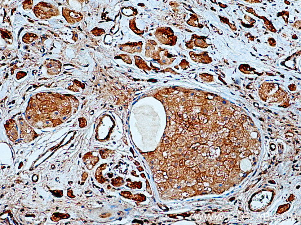 IHC staining of human breast cancer using 67292-1-Ig (same clone as 67292-1-PBS)
