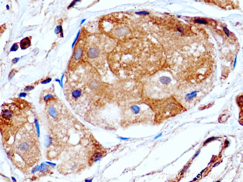 IHC staining of human breast cancer using 67292-1-Ig (same clone as 67292-1-PBS)