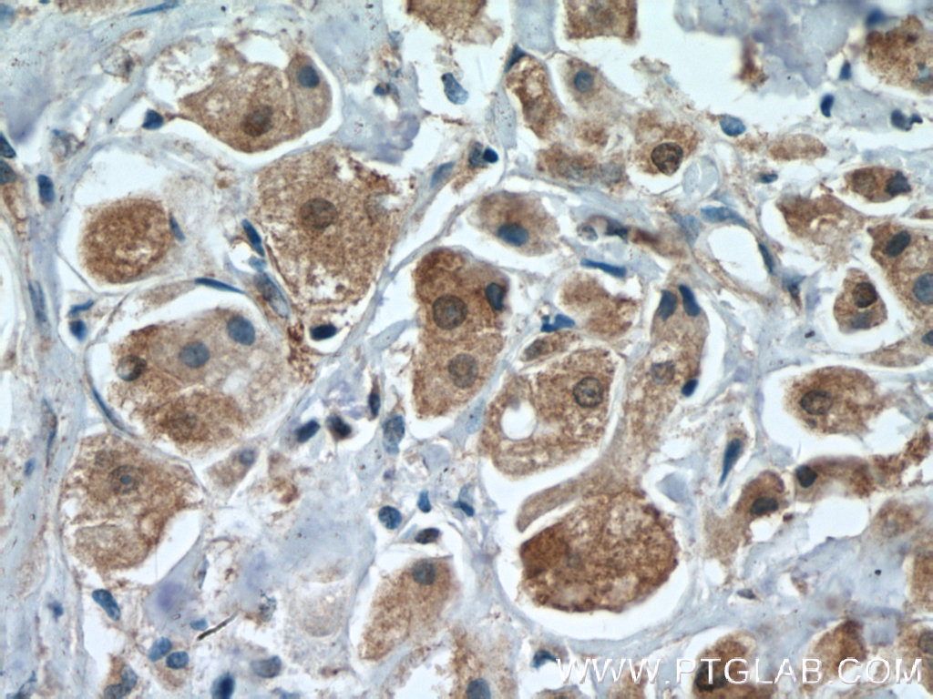 IHC staining of human breast cancer using 18436-1-AP